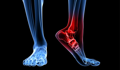 scarpe da calcio per fascite plantare